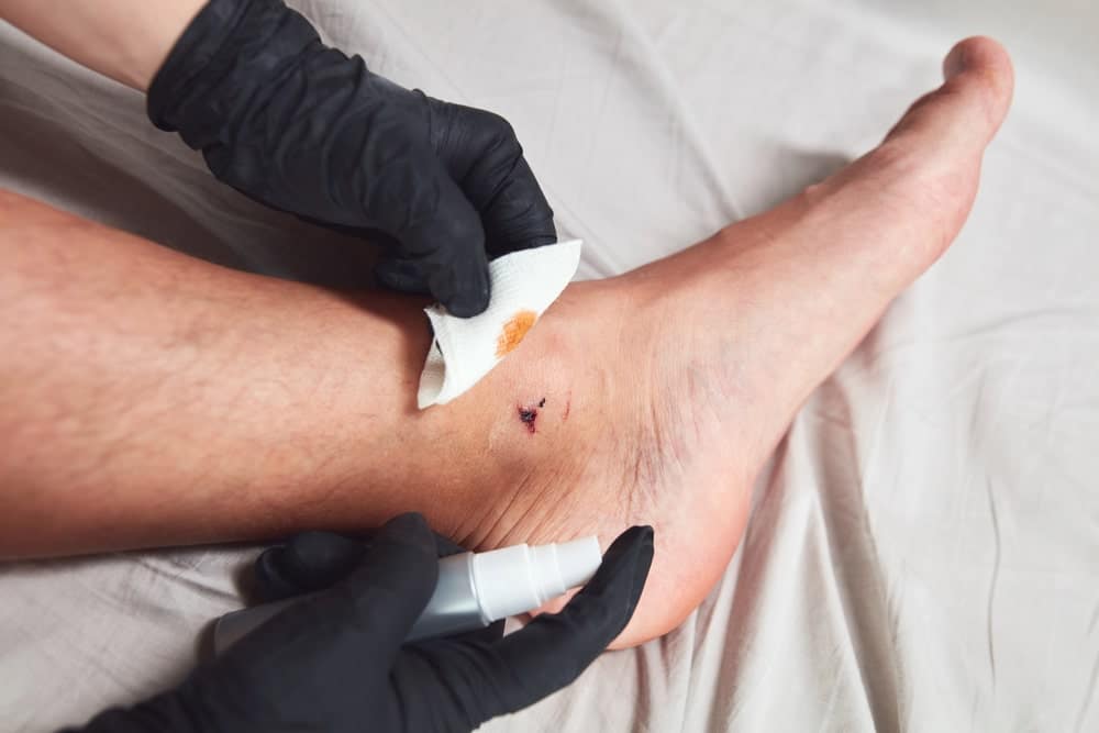 Image shows a person cleaning a puncture wound on the ankle with medical supplies, demonstrating proper first aid treatment after a dog bite in Nashville.