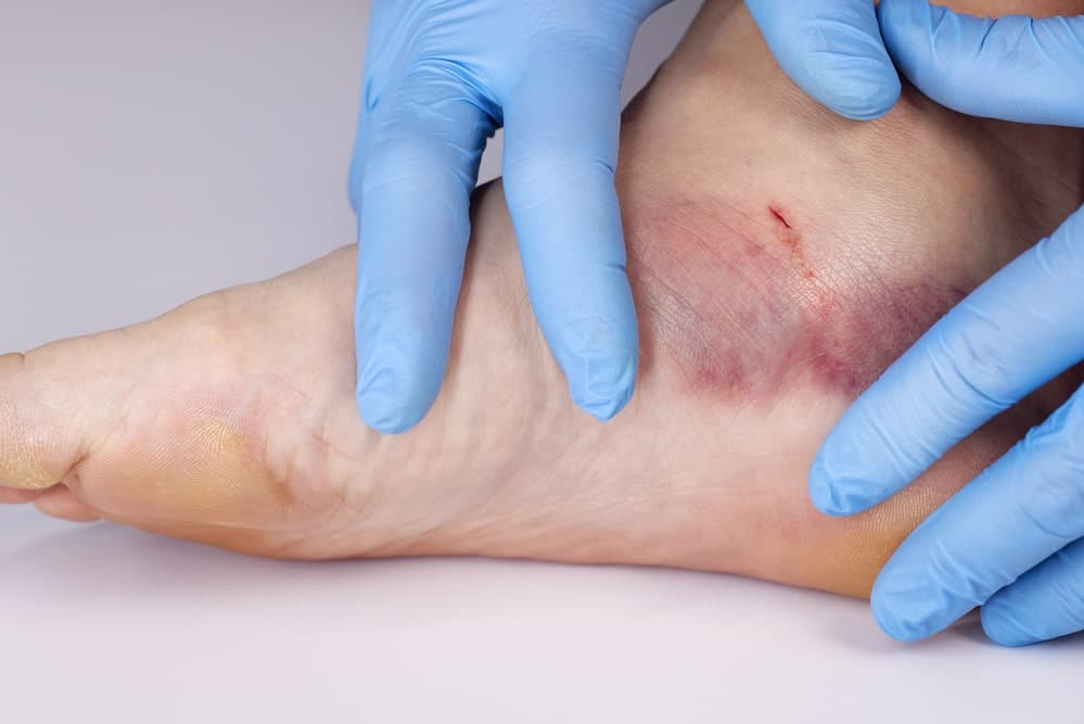 Image shows a swollen and bruised ankle with a small wound being examined by gloved hands, illustrating medical care steps after a dog bite in Nashville.