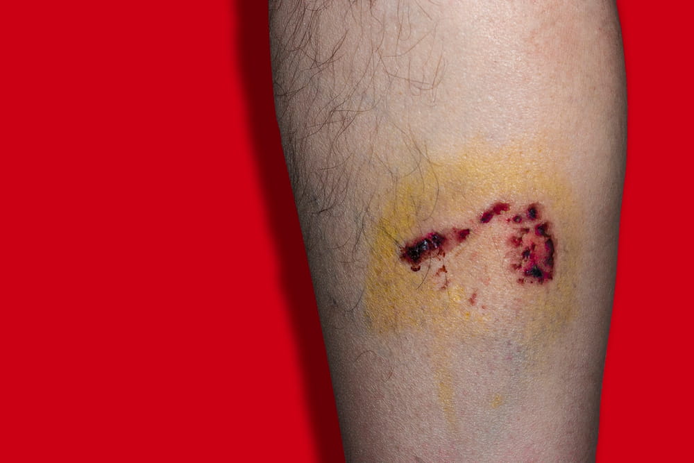 Image is of a visible bite wound on a person’s arm, concept of injury evidence in a dog bite claim