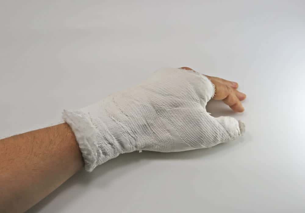 Image is of a hand wrapped in medical bandage after an injury, representing dog bite scarring and recovery process in a compensation case